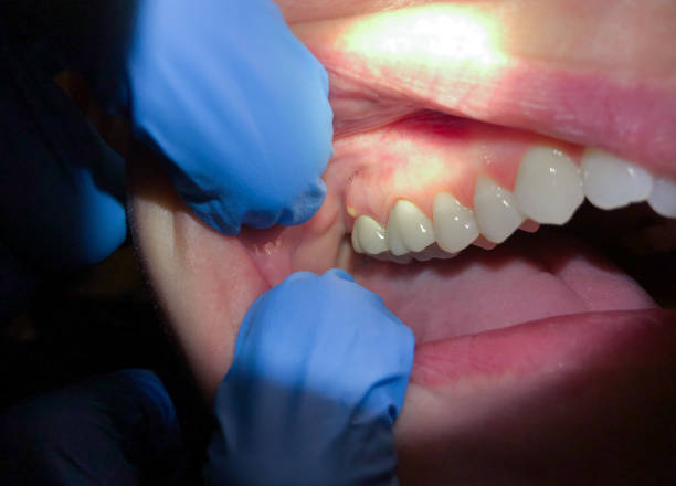 Best Emergency Treatment for Dental Infections or Abscesses in Seven Points, TX