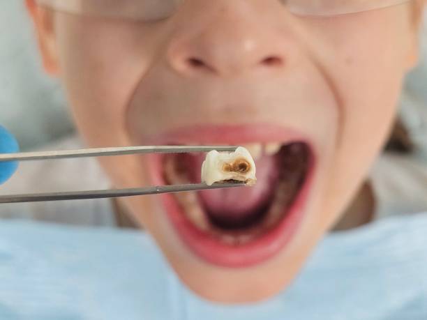 Best Emergency Tooth Extraction in Seven Points, TX
